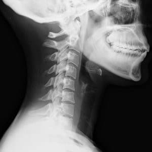 x-ray for neck injuries