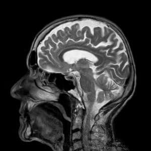 MRI of a patient with a brain injury