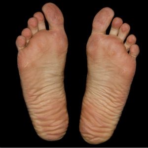 feet that have healed from injury