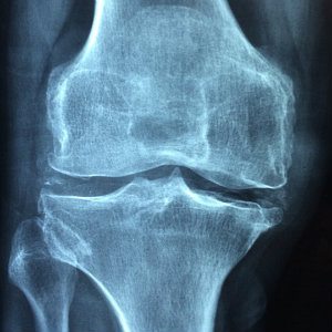 knee that sustained damage in fall