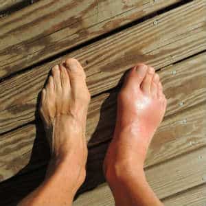 foot with complex regional pain syndrome