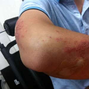 patient with skin infection and MRSA